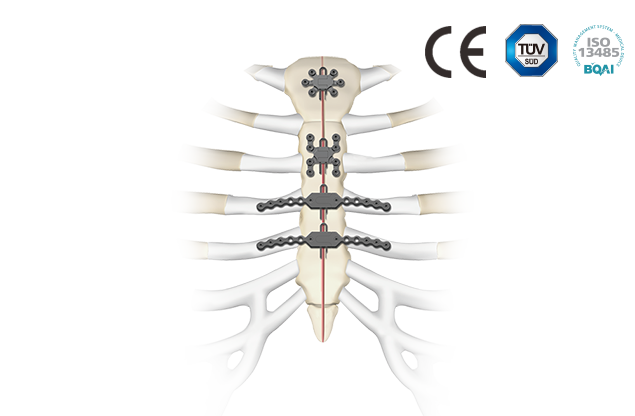 胸肋骨固定系統