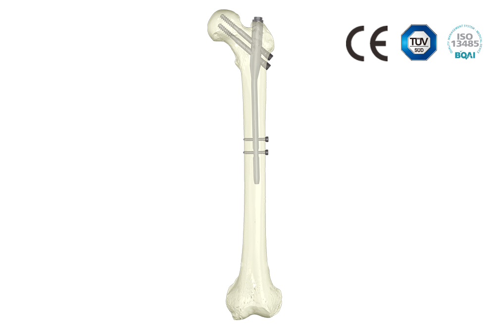股骨近端三型 髓內釘