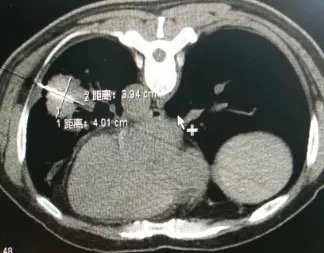 靶向®刀冷冻消融左肺浸润性腺癌伴纵隔淋巴结转移案例 靶向®刀冷冻消融左肺浸润性腺癌伴纵隔淋巴结转移案例