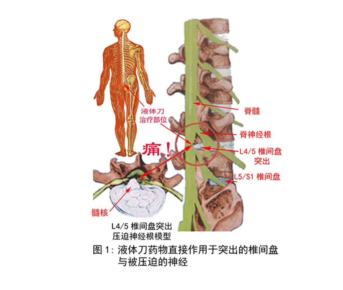 狭窄 脊椎 症 管 脊柱管狭窄症が、「歩くだけ」でなぜ良くなったのか？ （谷川